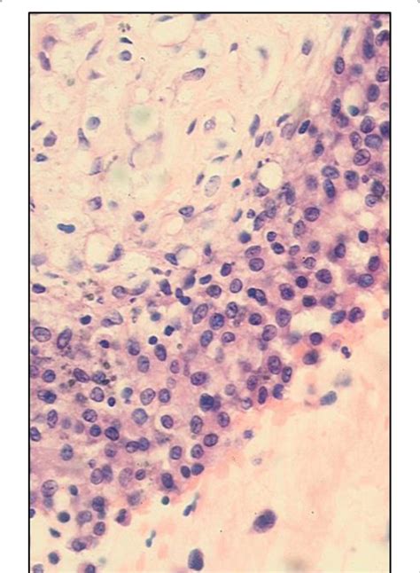 High Power View Of A Cell Block Of The Peritoneal Fluid Sample Showing