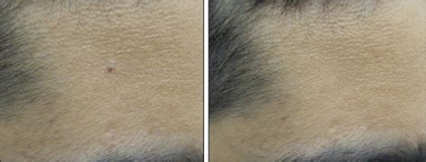 Laser Mole Removal in Chicago: Before and After Photos