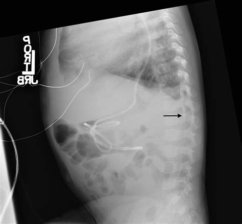 Peripherally Inserted Central Catheter Picc Placement Beware Of The