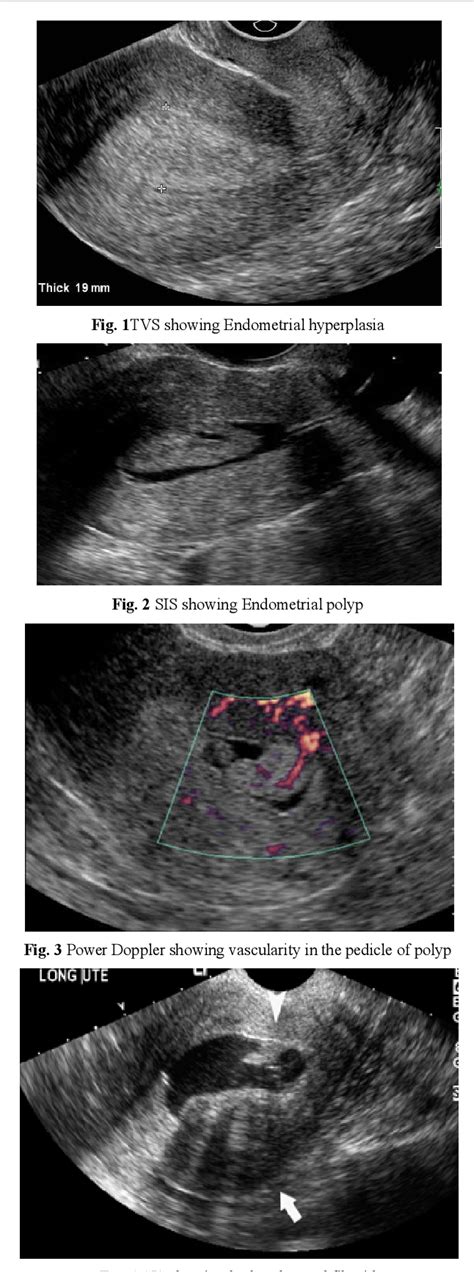 Uterine Polyps Ultrasound