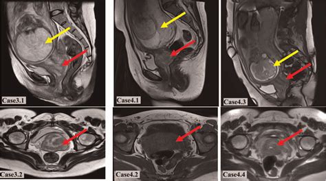 Case T Sagittal And T Coronal Pelvic Magnetic