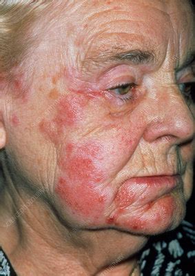 herpes rash on face - pictures, photos