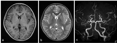 Preoperative Axial T1 Weighted A T2 Weighted B Magnetic Resonance Download Scientific