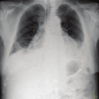 Pericardial biopsy presenting pericardial thickening, acute ...