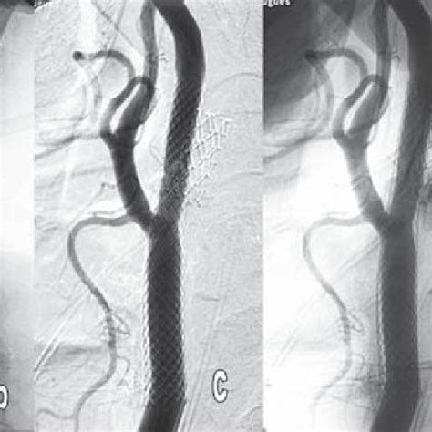 Arteriografia Digital Da Car Tida Esquerda A Demonstrando Estenose