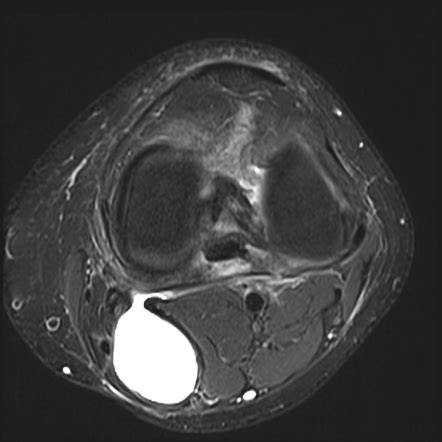 Baker Cyst Radiology Case Radiopaedia Org