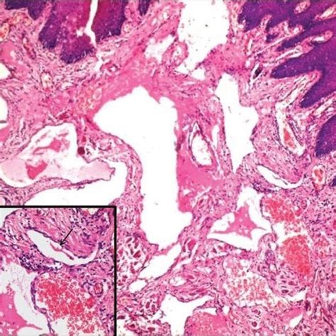 Photomicrograph Of Incisional Biopsy Showing Large Lymphatic Vessels H