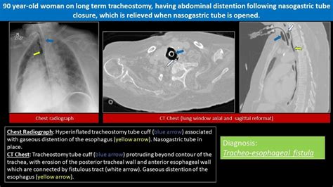 Iatrogenic Tracheoesophageal Fistula References Clinical Imaging