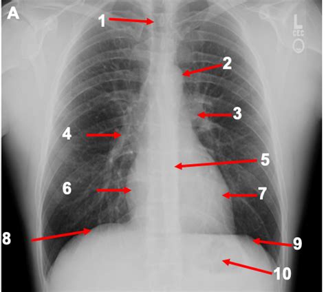 Anat Cvs Radiology Flashcards Quizlet