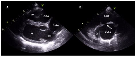 Veterinary Sciences Free Full Text Percutaneous Balloon Dilation In