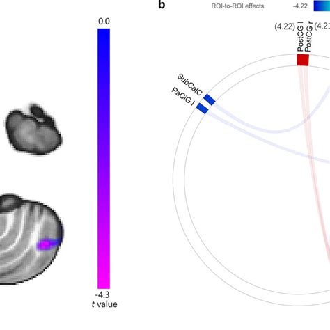 A Seed To Voxel Analysis Showing Lower Functional Connectivity Between Download Scientific