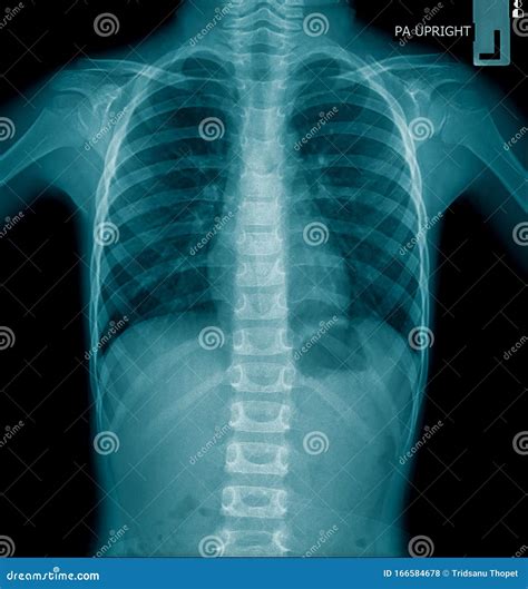 Human Chest X Ray X Ray Image Of Human Chest For A Medical Diagnosis