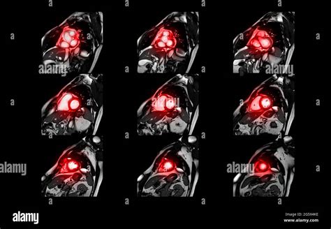 Imágenes de resonancia magnética cardiaca o cardiaca IRM del corazón en