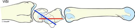 Wrist Instabilities Musculoskeletal Key