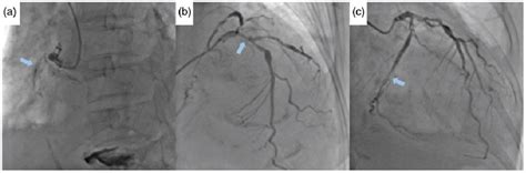 Figure 1 From Renal Artery Intervention For A Patient With Flash Pulmonary Edema Accompanied By