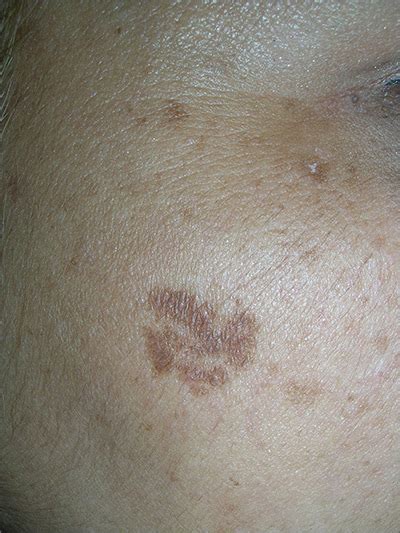 Light Brown Spots Appearing On Face | Americanwarmoms.org