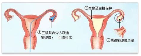 输卵管积水去香港做试管婴儿，原本50的成功率将下降到20 30 知乎