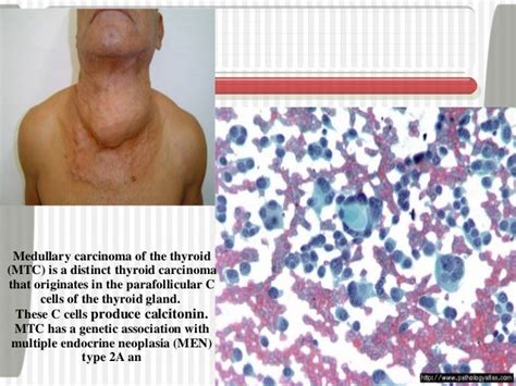 Thyroid Tumor