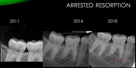 Root Resorption Treatment Rochester MN, Zumbro Valley Endodontics