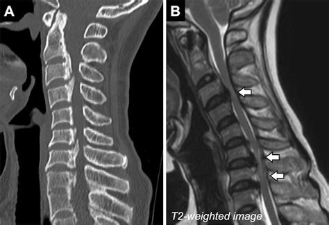 Ossification Of The Posterior Longitudinal Ligament Pathogenesis Hot Sex Picture