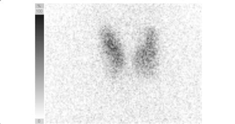 Thyroid Gland Uptake Of 123 I Scintigraphy Diffuse Uptake Of 123 I By