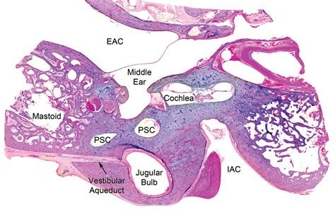 Jugular Fossa Ear