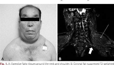 Figure 1 From Multiple Symmetric Lipomatosis Presenting With Bilateral