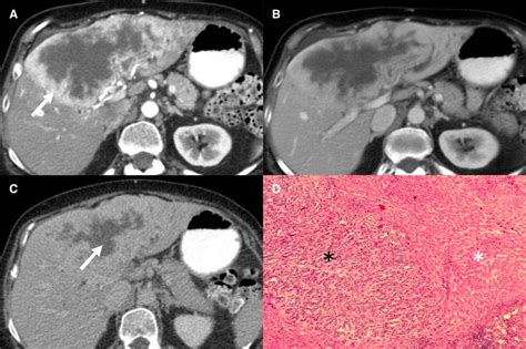 68 Year Old Female With Biliary Obstruction And Initial Imaging With