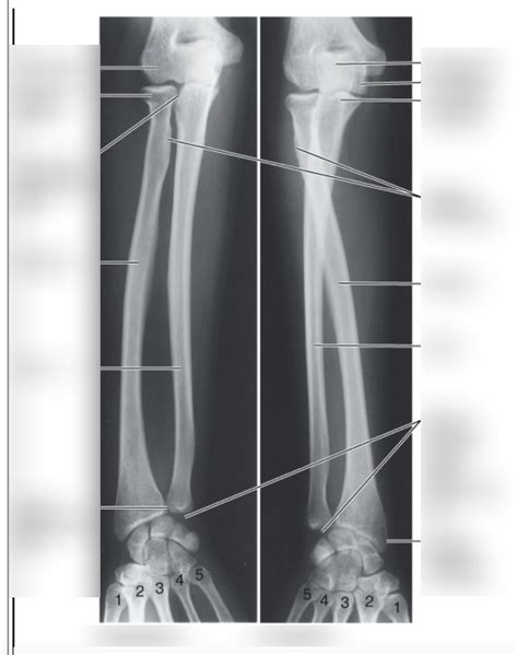 Label Forearm Plain Film Imaging Diagram Quizlet