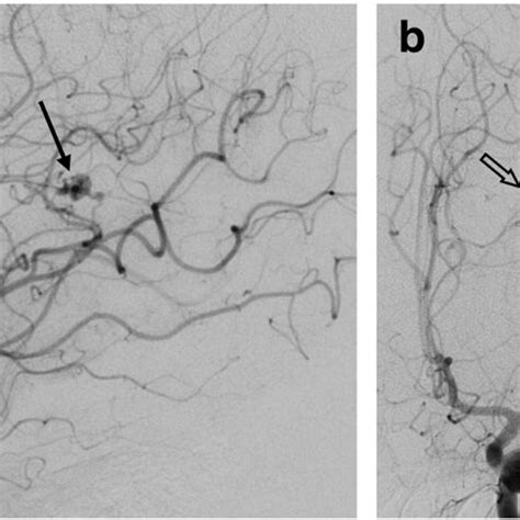 Cerebral Digital Subtraction Angiogram Left Internal Carotid Artery