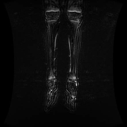 Chronic Recurrent Multifocal Osteomyelitis Image Radiopaedia Org