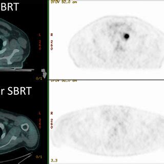 Patient Treated With Sbrt For A Nodal Metastases Dose Distributions In