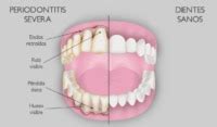 Cirug A Periodontal Cu Ndo Est Indicada Periodontium