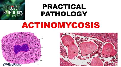 Practical Pathology Actinomycosis Youtube