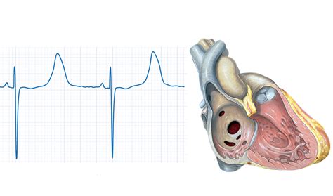 S Ndrome De Brugada Cardiavant