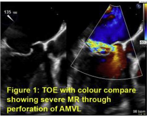 A Round Peg For A Torn Hole Percutaneous Closure Of Anterior Mitral