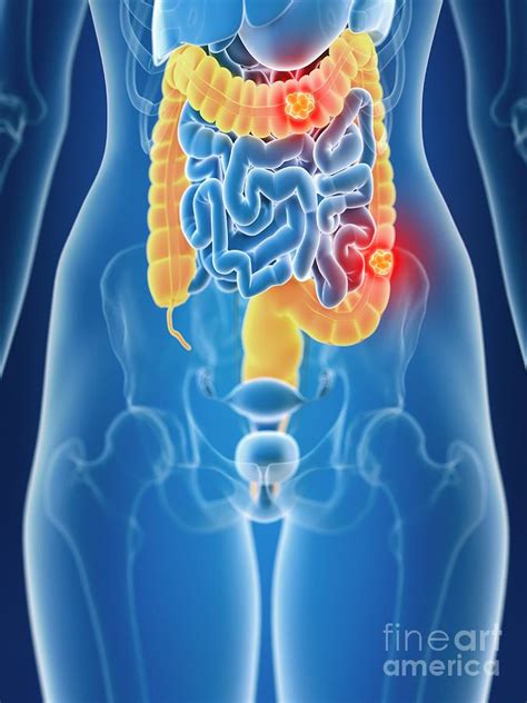 Illustration Of Female Colon Cancer Photograph By Sebastian Kaulitzki