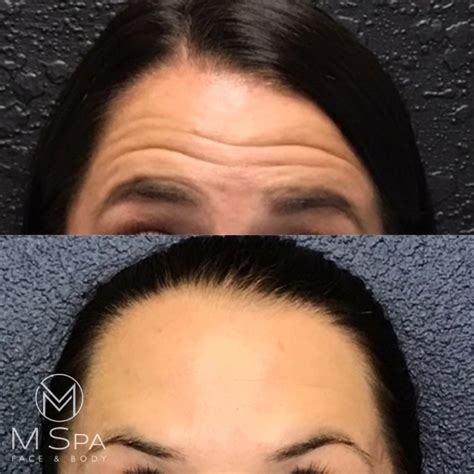 Botox Dysport Xeomin Case Medical Spa Houston Webster Tx M