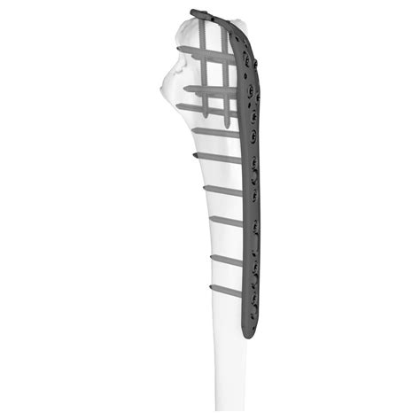 Olecranon Compression Plate Series Boneunion Medical Ulna