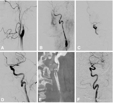 Figure From Stent Recanalization Of Carotid Tonsillar Loop Dissection