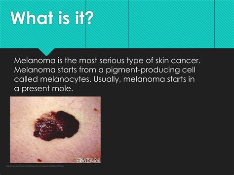 PPT - Desmoplastic Melanoma PowerPoint Presentation, free download - ID:3463473