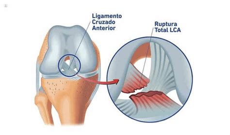 Lesiones En Arqueros C Mo Reducirlas