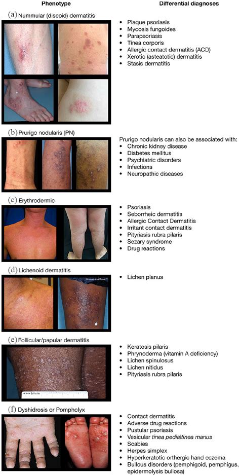 Nomenclature And Clinical Phenotypes Of Atopic Dermatitis Giampiero