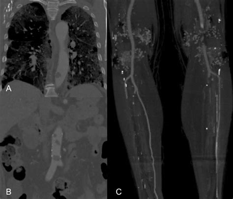 A And B Computed Tomography Angiography Cta Demonstrating Acute