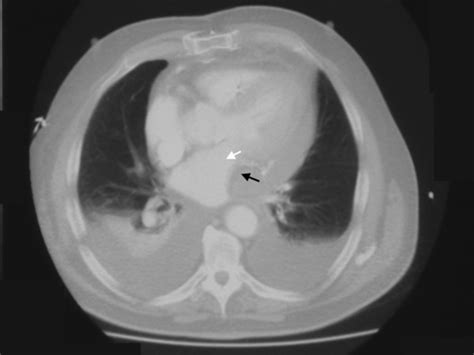 CT scan of the chest showing a large localised blood clot (black arrow ...