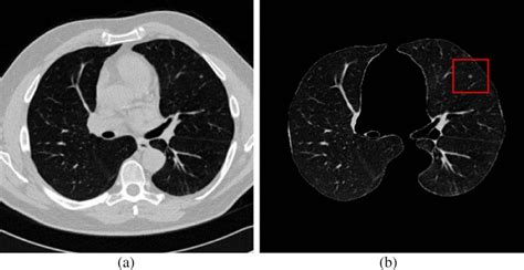 A Lung Ct Image B Lung Parenchyma Image Lung Parenchyma Image Is