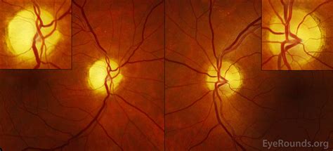 Bow-tie (band) atrophy secondary to compressive optic neuropathy