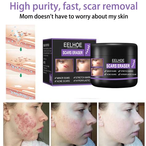 Scar Cream Scar Removal Cream Advanced Scar Treatment Gel For