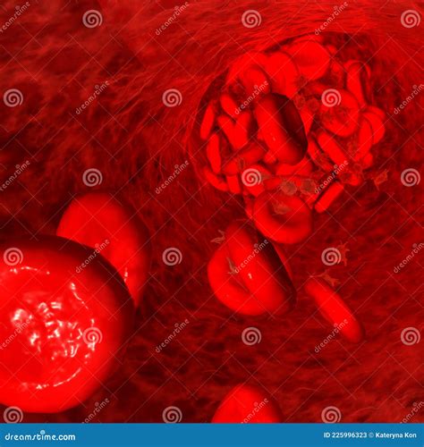 Blood Clot Made Of Red Blood Cells Platelets And Fibrin Protein