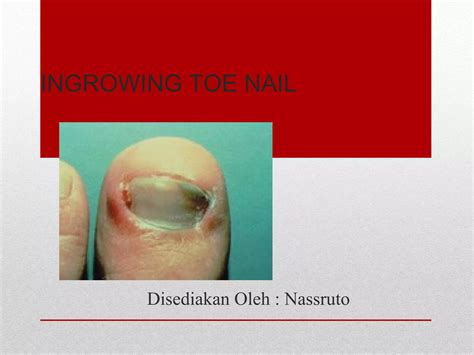 INGROWING TOE NAIL | PPT